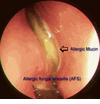 Fungal Sinus Infection